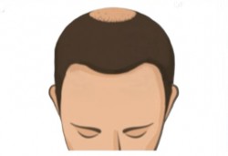 紋髮～ 髮轉加密法+ 髮縫或局部疤痕